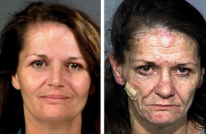 before and after crystal meth